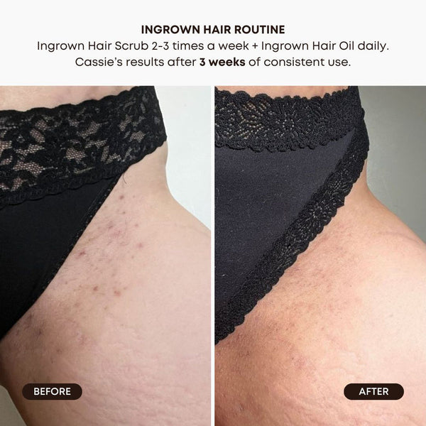 Ingrown Hair Pre-Post Wax Oil - Watermelon Sugar